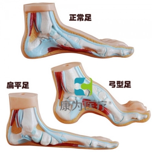 “康為醫(yī)療”正常足、扁平足、弓型足模型