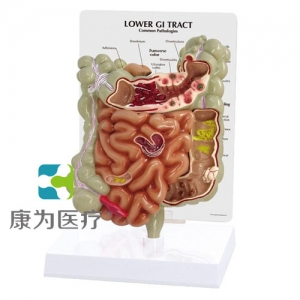 “康為醫(yī)療”醫(yī)患關(guān)系溝通模型-病理大、小腸模型（醫(yī)學(xué)指導(dǎo)模型）