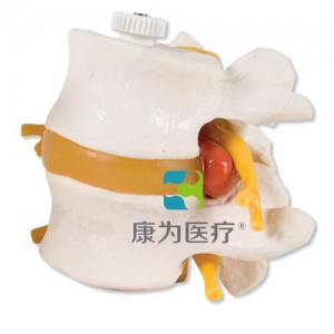 帶椎間盤脫出的2塊腰椎，活動安裝