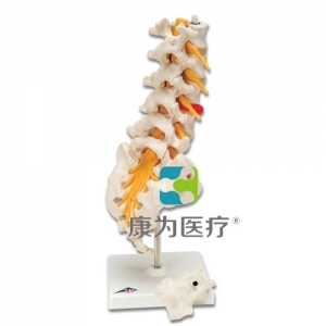 腰脊柱，有脊外側(cè)椎間盤脫出