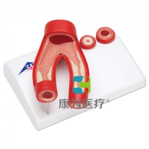 動脈硬化模型，帶動脈切面，2部分